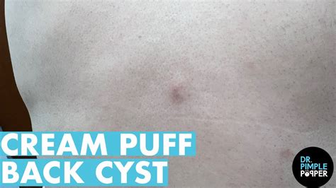 Dr Pimple Popper Opens The 'Gulf Coast' Cyst .